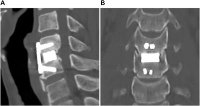 Long-term results comparison after anterior cervical discectomy with BGS-7 spacer (NOVOMAX®-C) and allograft spacer: A prospective observational study